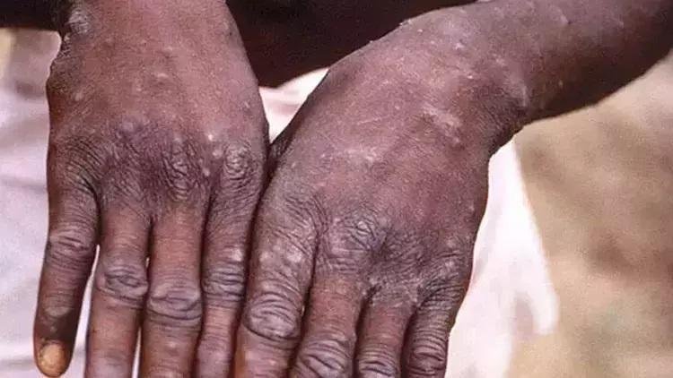 afrikada-maymun-cicegi-varyanti-nedir-belirtileri-ve-bulasma-yollari-4-d1BOfumD.jpg